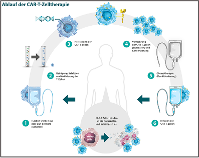 CAR-T-Zelltherapien: Personalisierte Krebsmedizin 2.0