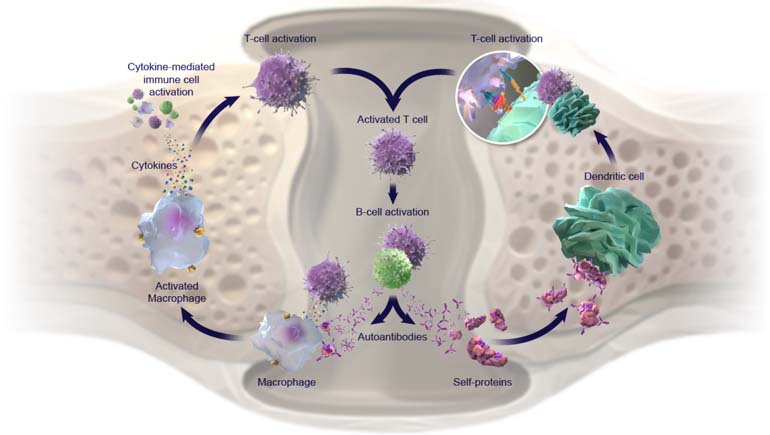 The Role of Pathogenic Drivers in Rheumatoid Arthritis - Bristol Myers